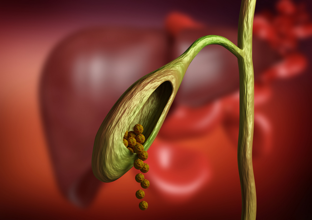 Gallbladder Stones Symptoms Causes Treatment